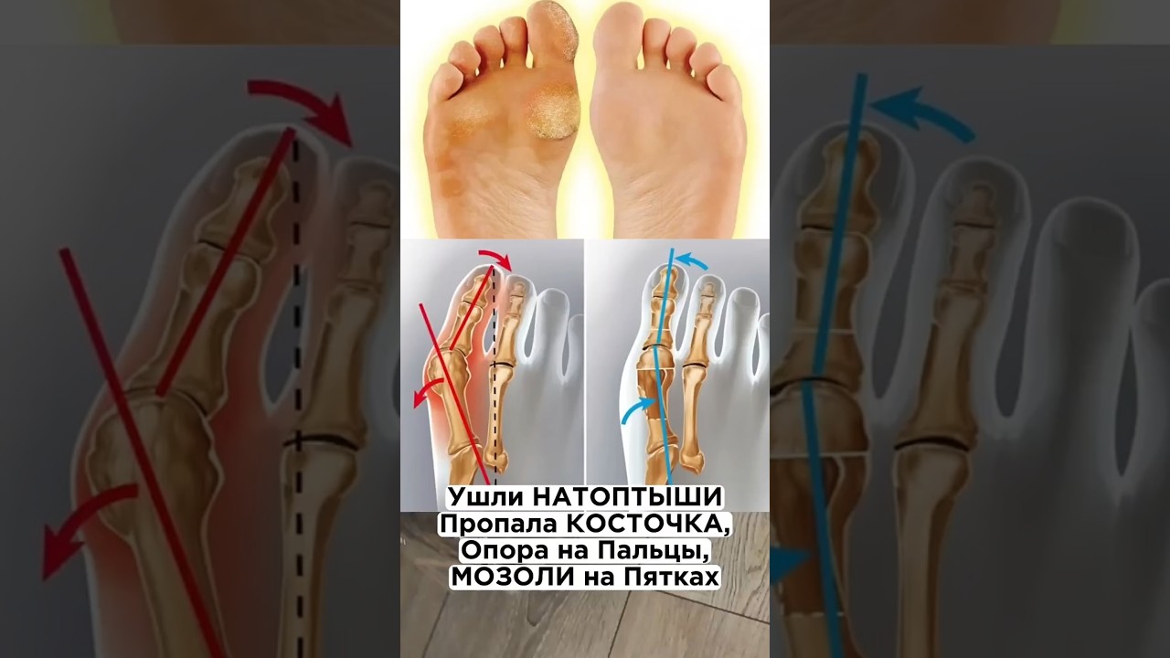 Ушли НАТОПТЫШИ, Исчезла КОСТОЧКА, Пропала Опора на Пальцы, Испарились МОЗОЛИ на Пятках 