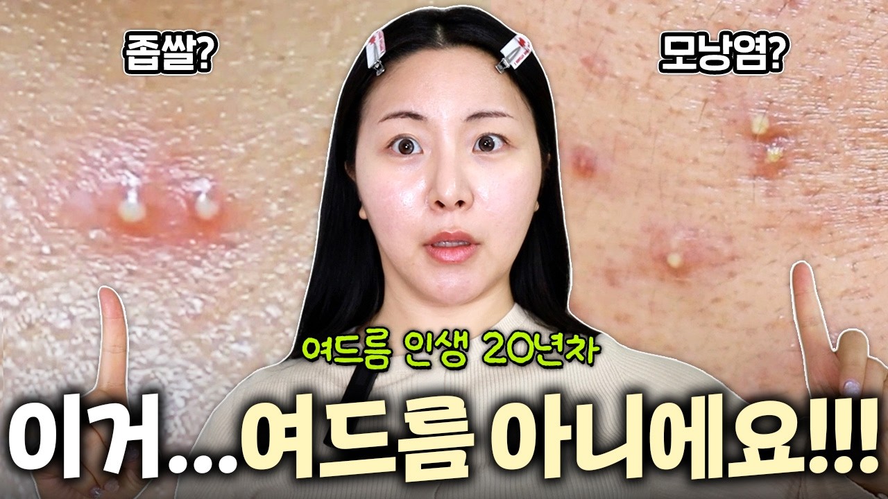 여드름인 줄 알고 짰다가 피부 다 망가집니다...당장 거울부터 보세요 (모낭염 구별법)