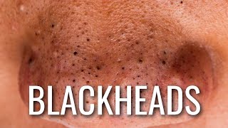 Here’s HOW To Stop Getting Blackheads
Find out why you get blackheads on your face and learn what to do to avoid getting blackheads in the first place.
Today I’m going to share the top 3 causes of blackheads and why they appear within the skin.
Firstly, Blackheads are little plugs of oil that have been blocked in the skin and then they oxidize in the sun causing that black/brown color. Blackheads are mostly found on our nose and chin however can be found all over the face and back too.
The Top 3 Causes of Blackheads
1. Blockages in the skin
2. Oil Quality
3. Skins PH Level
Interested in becoming a sponsor in one of our videos? Email us at hello@skinzoneacademy.com
Subscribe for new skincare videos weekly on SkinZone- https://www.youtube.com/channel/UCyK4n2FRJrLUhrj-oGcSOxw?sub_confirmation=1
MUSIC:
Royalty Free Music from Free To Use Music
Track: Home by Lukrembo
https://youtu.be/AWSyx6dUuwU
FAIR-USE COPYRIGHT DISCLAIMER
* Copyright Disclaimer Under Section 107 of the Copyright Act 1976, allowance is made for fair use for purposes such as criticism, commenting, news reporting, teaching, scholarship, and research. Fair use is a use permitted by copyright statute that might otherwise be infringing. Non-profit, educational or personal use tips the balance in favor of fair use.
1) This video has no negative impact on the original works
2) This video is also for teaching purposes.
3) It is transformative in nature.
Disclaimer: This video is not intended to provide diagnosis, treatment or medical advice. Content provided on this Youtube channel is for educational purposes only. Please consult with a physician or other healthcare professional regarding any medical or health related diagnosis or treatment options. Information on this Youtube channel should not be considered as a substitute for advice from a healthcare professional. The statements made about specific products throughout this video are not to diagnose, treat, cure or prevent disease.
#blackheads #acne #blockedpores
Inspired By:
SAC DEP SPA - Relax Every Day With Sac Dep Spa #425
URL: https://www.youtube.com/watch?v=c2nSPB6nbm8
Ng TD - 1: Blackheads & Acne Treatment Hottest Videos #111
URL: https://www.youtube.com/watch?v=WdqH1JAUdTI
SAC DEP SPA
SAC DEP SPA Here’s HOW To Stop Getting Blackheads