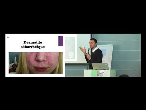 Vidéo: Lupus Sur Le Visage - Causes, Symptômes, Diagnostic Et Traitement Du Lupus Sur Le Visage