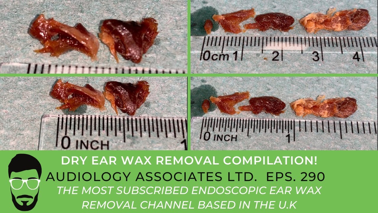 DRY EAR WAX REMOVAL COMPILATION EP 290 YouTube
