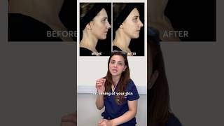 Polynucleotides explained: how are they different from fillers?