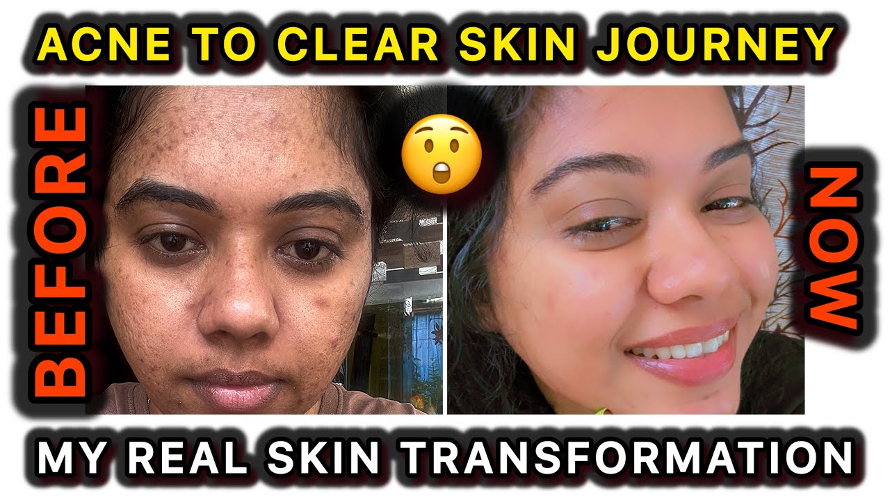 🤩எப்படி எனக்கு முகப்பரு குறைந்து?| How I Got Clear Skin | My Night ...