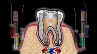 Root Canal Treatment