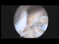 Don buford md arthroscopic rotator cuff repair