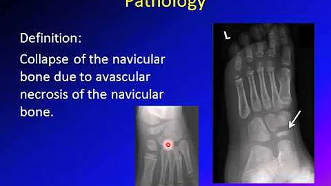 Kohler's Disease