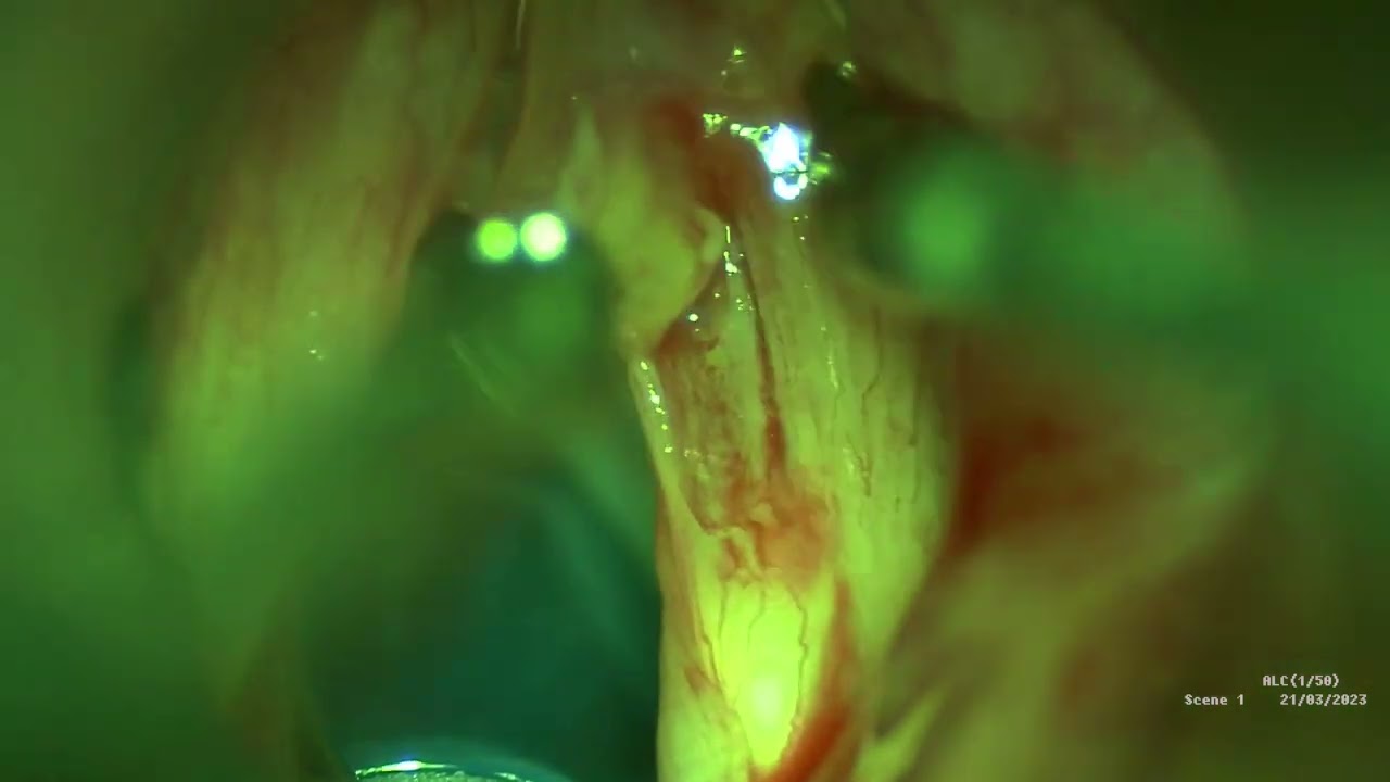 Vocal Cord cyst excision
