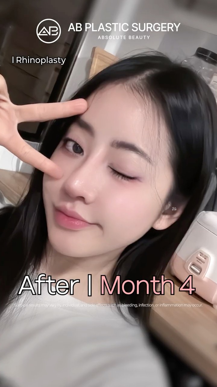 Rhinoplasty Before & After | Amazing Glow Up #shorts