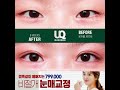 📢 수능 수험생 자연유착 쌍꺼풀 33만원 이벤트