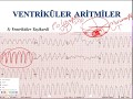 EKG - Ventriküler Aritmiler (ECG - Ventricular Arrhythmias)