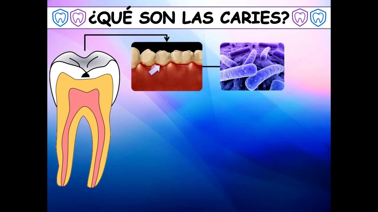 Bioquímica de la caries dental YouTube