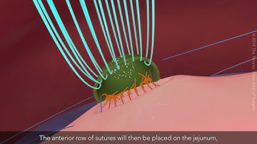 Complex biliary reconstruction: Hepatico-jejunostomy with 3 hepatic ducts