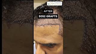 Transform Your Hair Discover Life-Changing Results At Vj Clinic