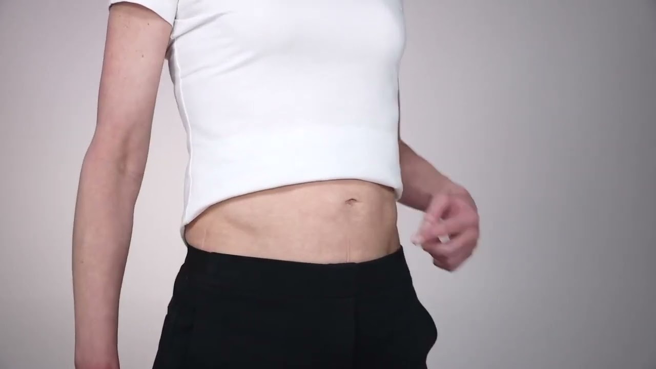 PL - Film instruktażowy do wstrzykiwań Decapeptyl | UMC Utrecht