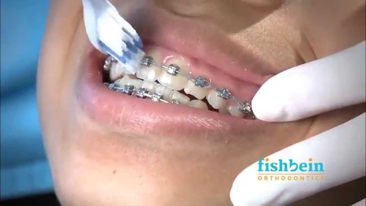 Orthodontic Home Care Instructions Braces Brushing YouTube