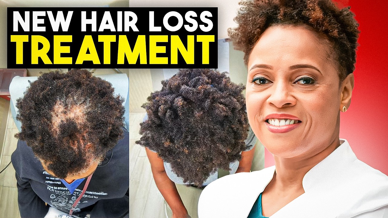 The Non Surgical Hairloss Treatment You NEED To Know About: Alma TED Explained