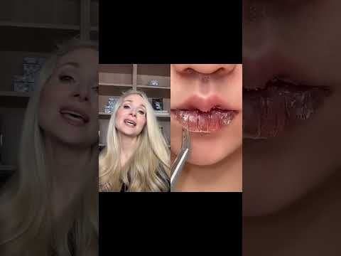 Video: 3 manieren om exfoliatieve cheilitis te genezen