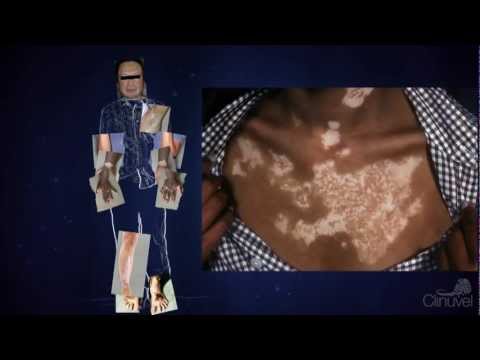 Video: 7 Misconceptions About Vitiligo