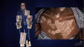Understanding Vitiligo: Misconception & Myth