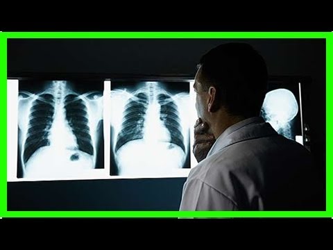 Was ist Lungen-Bronchiektase und wie wird sie behandelt?