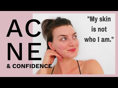How to Have Confidence with Acne