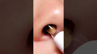 Watch This Blackhead Get Pulled Out by Vacuum 😳