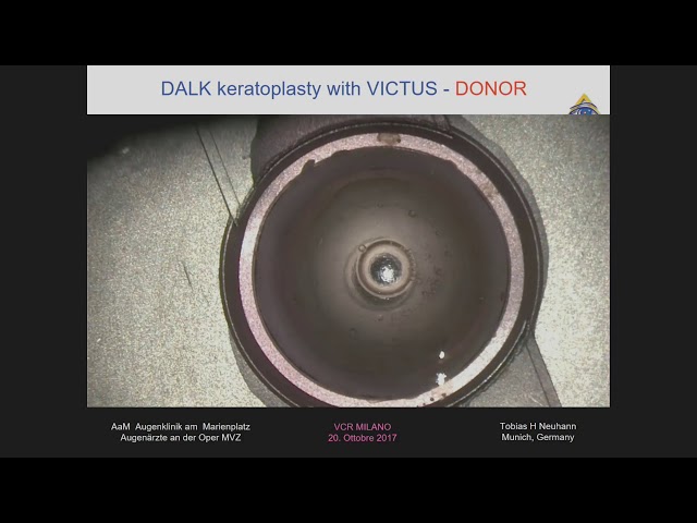 Vcr 17 Surgery From Munich Dalk With Victus Surg Tobias Neuhann Okyo