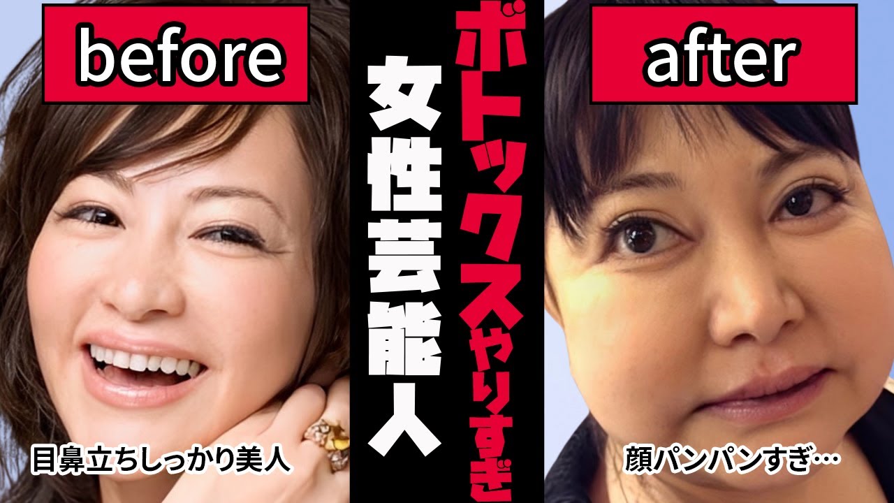 ボトックス やりすぎ 芸能人