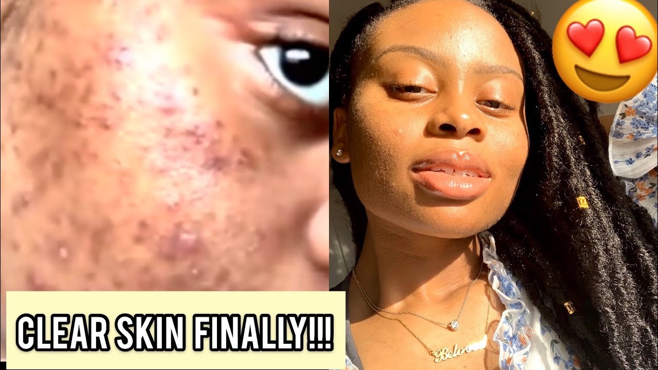 I FADED MY ACNE SCARS + GOT CLEAR SKIN DOING THIS - YouTube