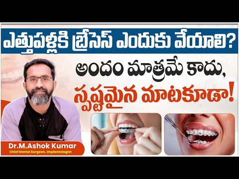 ఎత్తుపళ్లకి బ్రేసెస్ ఎందుకు వేస్తారు | Different Types of Braces for Teeth | Eledent Dental Hospital - video from Eledent