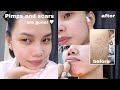 Getting Rid of My Acne and Scars | may pimples na naman! 😥