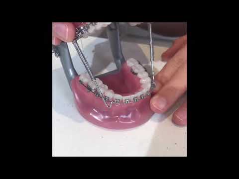 Forsus Spring - YouTube