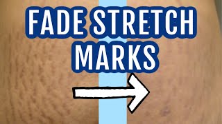 7 ways to fade stretch marks| Dr Dray