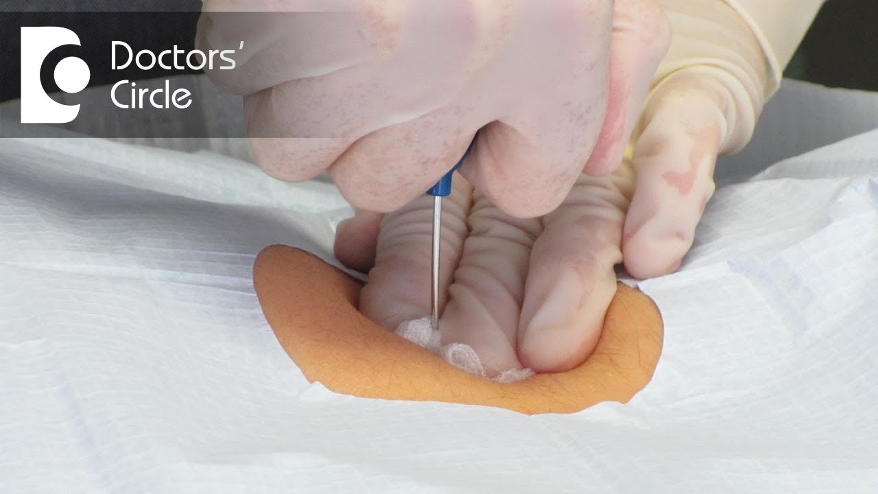 What is bone marrow transplantation? - Dr. Mallikarjun Kalashetty