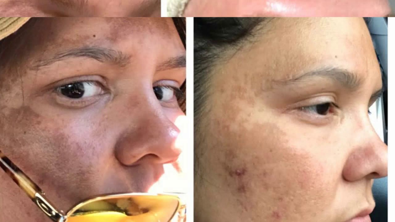Admire My Skin Dark Spots Video YouTube