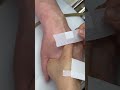 Intramuscular Injection Technique Explained | Safe IM Injection Step-by-Step | Nurse Guide Class 32