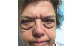 Patient Stories | Brow Lift, Quad Blepharoplasty, Fat Repositioning and Co2 Laser | Beverl