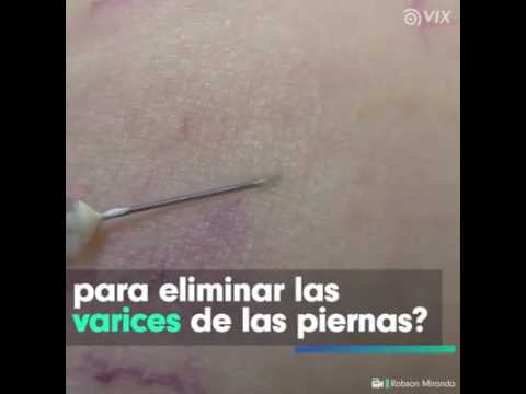 Como quitar las varices rapido