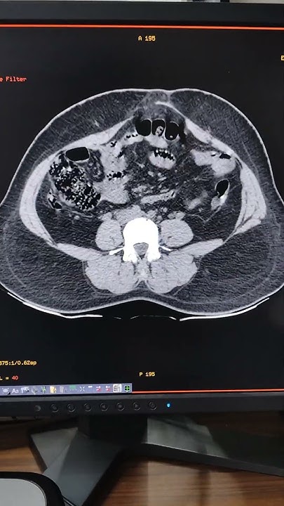 painful-belly-button-bump-do-you-have-an-abdominal-hernia