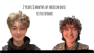 Non Binary HRT Journey: Over 2.5 Years on 'Medium' Dose Testosterone