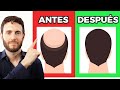 Alopecia: Cómo frenar la caída del cabello en hombres y mujeres