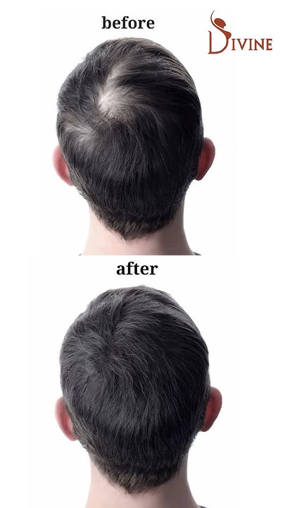 best-treatment-for-hair-fall-and-hair-thinning-gfc-and-prp