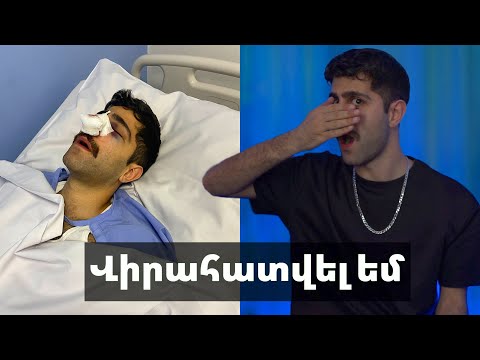 Video: Թոփ 5 աստղերը, ովքեր կատարել են քթի ռինոպլաստիկա