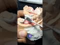 prótesis peek