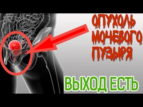 Беспокоит ОПУХОЛЬ МОЧЕВОГО ПУЗЫРЯ? Изучены основные ПРИЧИНЫ возникновения опухоли МОЧЕВОГО ПУЗЫРЯ