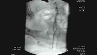 Fluoroscopic Caudal Epidural Contrast Spread