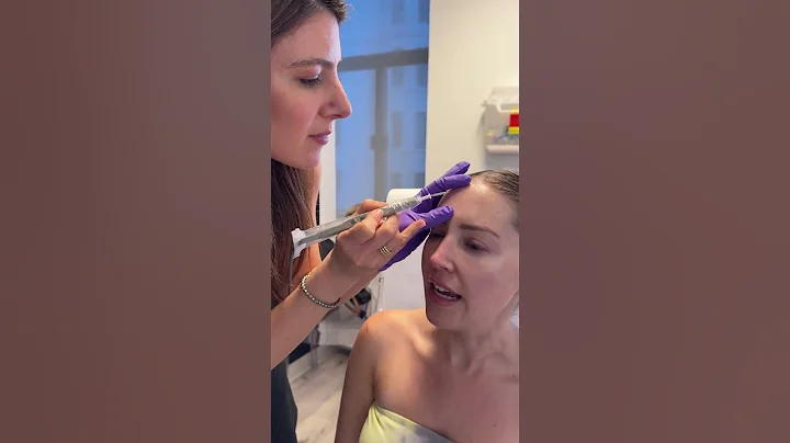 Footage of my Sebaceous Hyperplasia being Electrocauterized