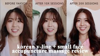 YAKSON HONEST REVIEW | Non-Surgical Facial For V-Line + Small Face (BEFORE/AFTER 20X SESSIONS)