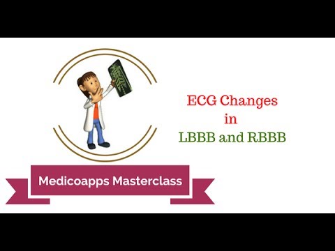 ecg-changes-in-lbbb-and-rbbb