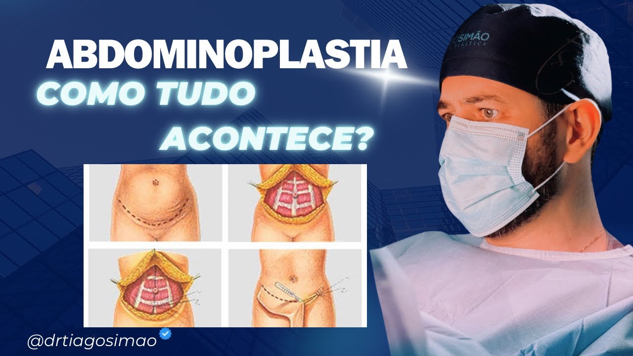 ABDOMINOPLASTIA | TUDO SOBRE ESSA CIRURGIA | PRÉ / PÓS CIRÚRGICO!